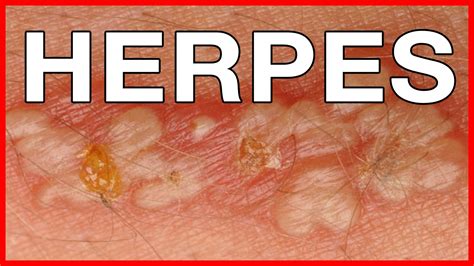 herpes genital-1